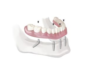 Full Mouth Dental Implants 
